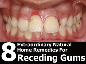 natural-remedies-for-receding-gums-600x450
