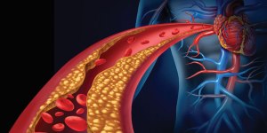 real-cause-of-heart-disease-inflammation-immunocal-platinum-glutathione-cytokine-modulating-proteins-cholesterol